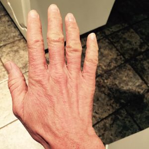 Right hand at Month 5 of TSW